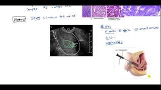 Endometrial Cancer and Hyperplasia for USMLE [upl. by Anyehs7]