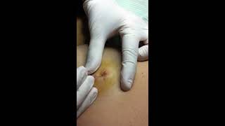 Sebaceous Cyst Extraction [upl. by Ledah989]