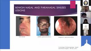 Lesi Jinak Hidung dan Sinus Paranasal Inverted Papiloma [upl. by Notrom429]