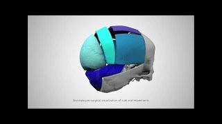 3D Systems VSP Cranial Service [upl. by Telfore]