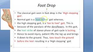 Orthopedics 085 Foot drop sciatic High stepping Toe to Heel Gait Ober Barr Common Peroneal lateral [upl. by Nnalyrehs]