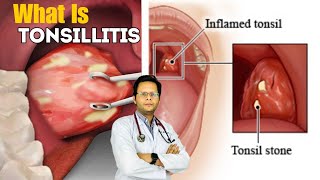 Tonsillitis  Causes Signs Treatment Symptoms In Hindi [upl. by Aniad]