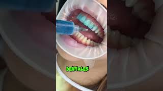 Carillas Vs Brackets dientes dentista tips parati viral fyp shorts shortvideo fypシ [upl. by Alejo]