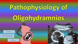 Pathophysiology of Oligohydramnios in Pregnancy [upl. by Demah]