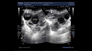 Ultrasound Video showing Three types of Cysts in the same patient [upl. by Helbonia]