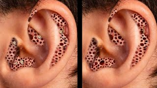 Infected Ear   disprineasmr11 [upl. by Candide]