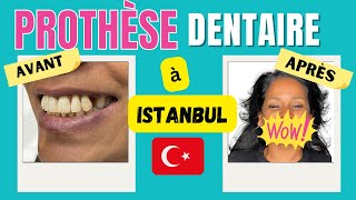 IMPLANTS DENTAIRES AVANT APRÈS à Istanbul je vous explique tout [upl. by Ynove172]