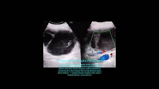 Retroperitoneal complex cystic lesion  hydatid disease  abscess [upl. by Changaris]