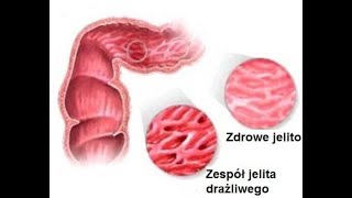 Zespół jelita drażliwego – 4 porady by złagodzić objawy [upl. by Nnorahs]