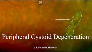 Peripheral Cystoid Degeneration Peripheral Retinal Degenerations [upl. by Ecirtel]