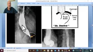 Esophageal disorders in Arabic 3  Achalasia of esophagus part 2   by Dr Wahdan [upl. by Woodrow]