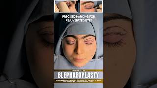 Brighten Your Eyes with Blepharoplasty  Sarayu Clinics beauty [upl. by Vani552]