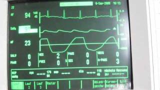 breath hold EKG with oxygen desaturation [upl. by Fenny]