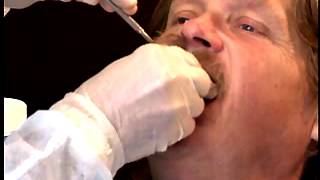 Complete Denture Procedure  01 Maxillary Preliminary Impression [upl. by Soinski180]