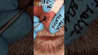 Nose Blackheads  Removal by DrLalit Kasana [upl. by Resaec]