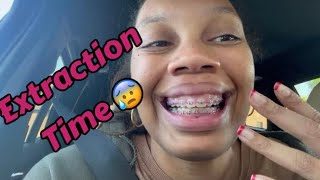 Dentist Vlog 4  Is it worth it Tooth Extraction Finally [upl. by Airitac]