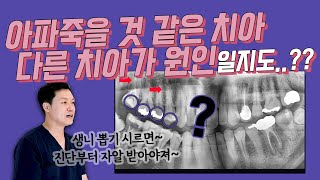 급성치수염 이라고 해서❗신경치료 받았는데 왜 계속 아프지❓혹시 진단이 잘못 된건가❓❗❗😂 해외출국을 앞뒀지만 치료는 제대로 받읍시다 [upl. by Onaicram]