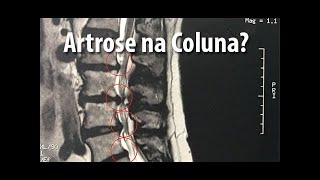 Artrose na Coluna Hérnia de Disco Bico de Papagaio Protusão Discal Fisioterapia Dr Robson Sitta [upl. by Duj]