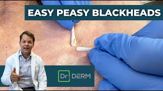 Easy Peasy Blackheads  Dr Derm [upl. by Mallissa]