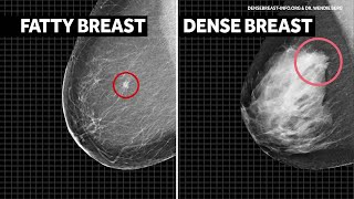 FDA sets new guidelines requiring mammogram providers to notify about breast density [upl. by Bbor189]