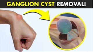 GANGLION CYST REMOVAL  Medical students [upl. by Evangelina171]