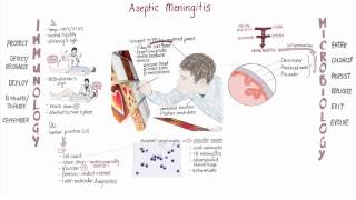 Enterovirus Meningitis Springboard [upl. by Ecyaj]