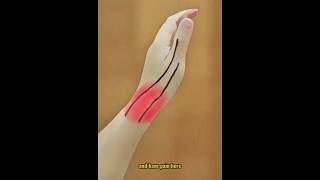 De Quervains Tenosynovitis Quick Fix in 5 Steps [upl. by Eudosia470]