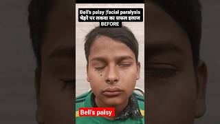 sleep one side facial paralysis  Bells palsy  bellspalsy facialparalysis paralysisinhindi [upl. by Nosydam863]