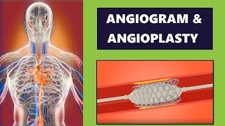 Angiogram and Coronary Angioplasty Procedure Cardiology [upl. by Onafets]