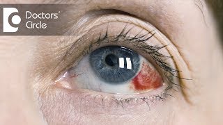 Causes of red clots in eyes  Dr Mala Suresh [upl. by Lhok]