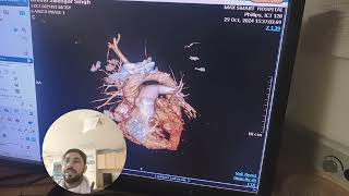 CT pulmonary Angiography Procedure Detailed Explanation part2 avnishradiology [upl. by Ennaeel]