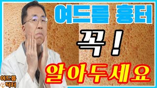 여드름 흉터❗꼭❗알아두세요 여드름흉터 여드름흉터없애는방법 여드름흉터없애는법 여드름자국 [upl. by Audrye805]