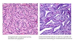 Sertoli cell tumorGYNpath [upl. by Laith592]