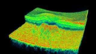 Topcon 3D OCT  Soft Drusen [upl. by Gillette]