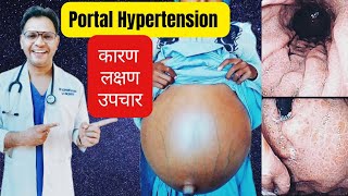 portal hypertension sign and Symptoms and management [upl. by Tris957]