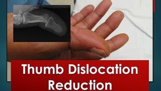 Thumb Dislocation Reduction [upl. by Salkin]