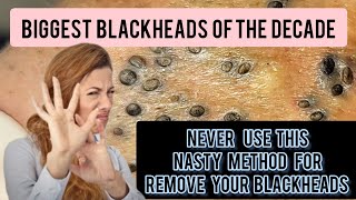 Nasty and lengthy blackhead removal bent needle historical method DrAMAZINGSKIN [upl. by Sibylla]