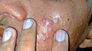 sac be spa blackheads elderly 2024  sac be spa old age blackheads 2024  sac be spa face scrub 461 [upl. by Annaeoj]