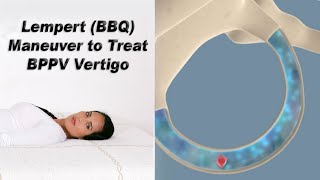 Lempert BBQ Maneuver to Treat BPPV Vertigo [upl. by Einhoj480]