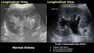 Hydronephrosis Grading Ultrasound  Kidney USG Scan Normal Vs Abnormal Images  Grades 1 2 3 amp 4 [upl. by Gamin]