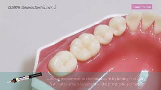 How to with UBQ 2 Cementation of Indirect Restorations [upl. by Bascio160]