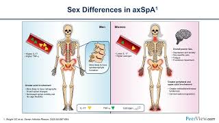 Recognition and Management of Axial Spondyloarthritis Best Practices for Family Medicine Physicians [upl. by Nariko]