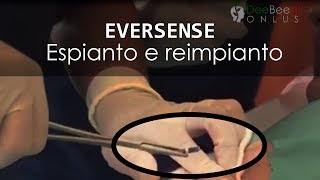 EVERSENSE  Il sensore sottopelle Espianto e reimpianto nello stesso sito [upl. by Morrie]