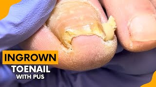 Ingrown Toenail Filled with Pus [upl. by Zzabahs45]