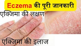 Eczema क्या हैं  Eczema की पूरी जानकारी  eczema kya hota hai  eczema ka ilaj [upl. by Perzan]