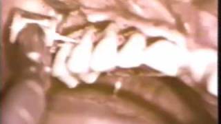 Osseous Surgery in the Maxilla [upl. by Jolda]