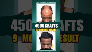 Hair Transplant Results  Before and After hairtransplantresults hairtransplant shorts [upl. by Ilenna567]