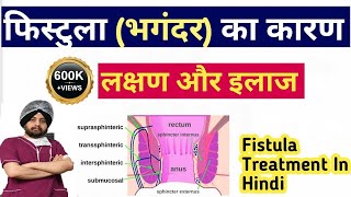 Fistula in Hindi Definition Symptoms Treatment Surgery How Fistula Cure Without Surgery [upl. by Sue]