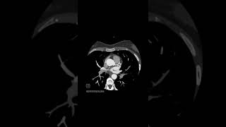 Artéria Coronária esquerda tomografia anatomia coronarias [upl. by Jenn298]