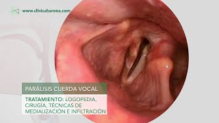 Disfonía Lesiones de las cuerdas vocales [upl. by Neerol]